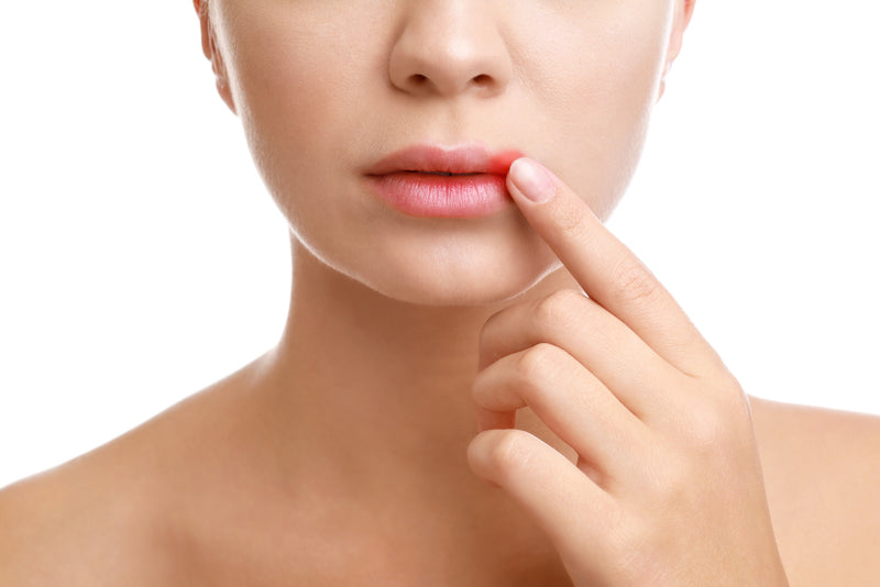 How To Manage Cold Sores With Food